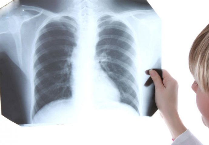 Karcinom pluća odnese 4 500 života godišnje